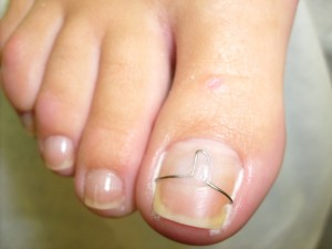 Процедура лечения вросшего ногтя скобами