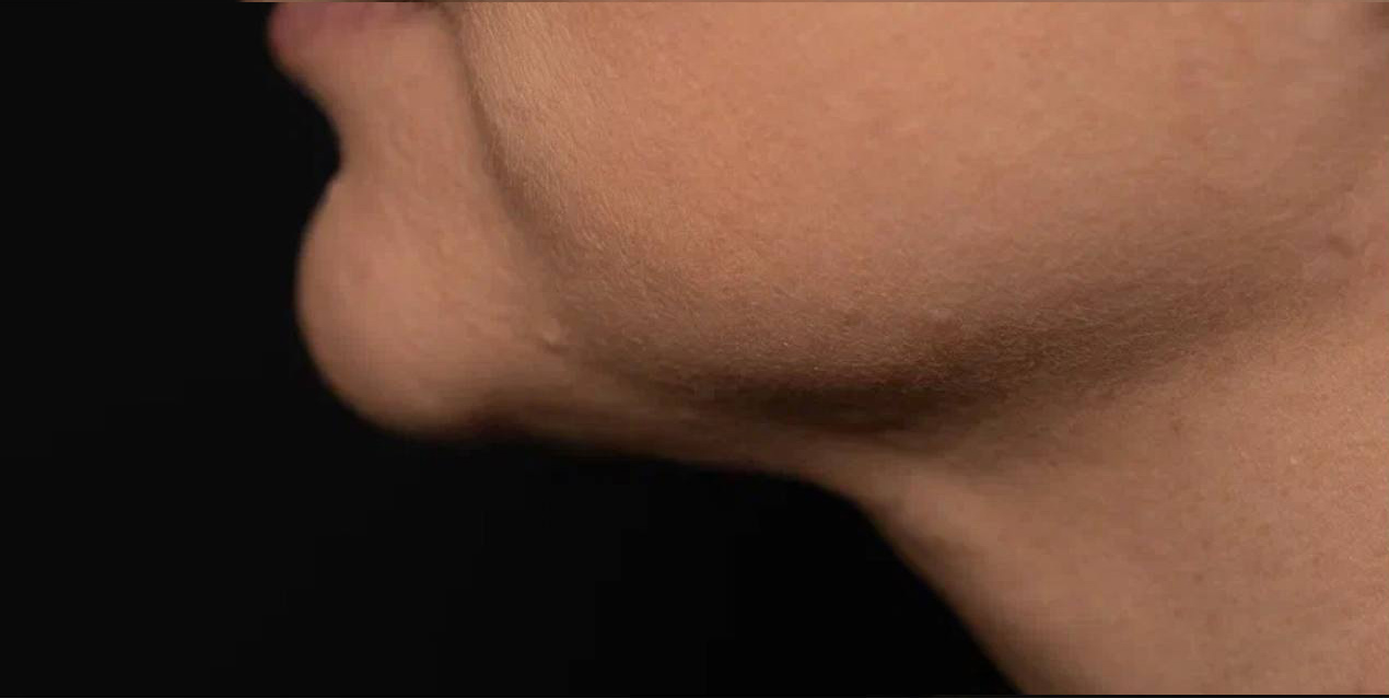 FaceTite | малоинвазивный лифтинг - После