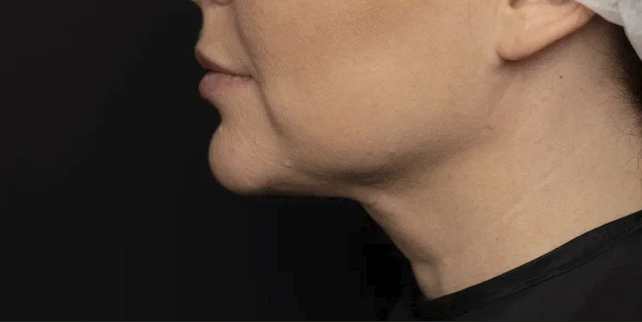 FaceTite | малоинвазивный лифтинг - После