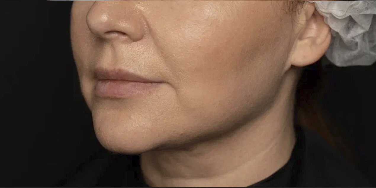 FaceTite | малоинвазивный лифтинг - После