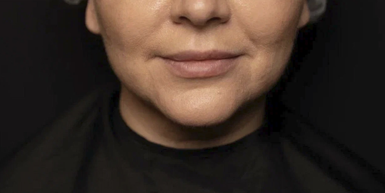 FaceTite | малоинвазивный лифтинг - После