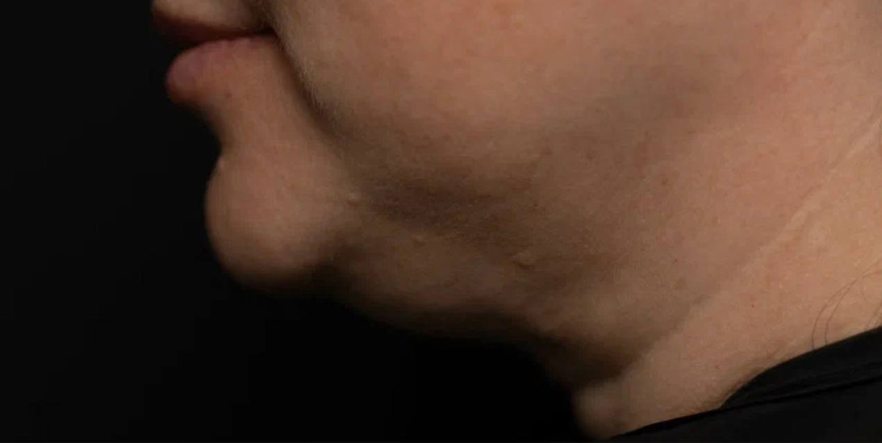 FaceTite | малоинвазивный лифтинг - До