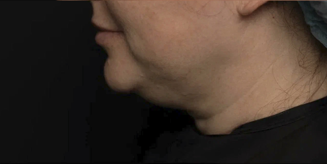 FaceTite | малоинвазивный лифтинг - До