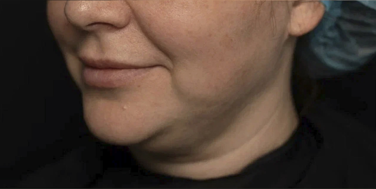 FaceTite | малоинвазивный лифтинг - До