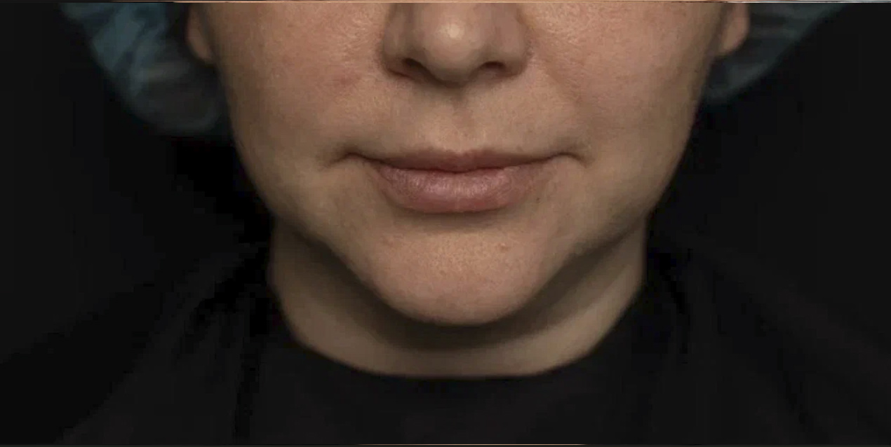 FaceTite | малоинвазивный лифтинг - До