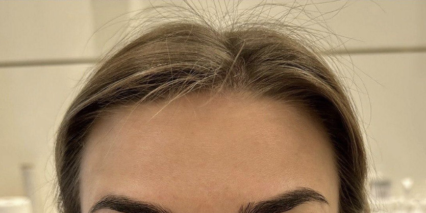 Ботулинотерапия - После