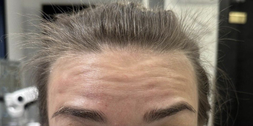 Ботулинотерапия - До