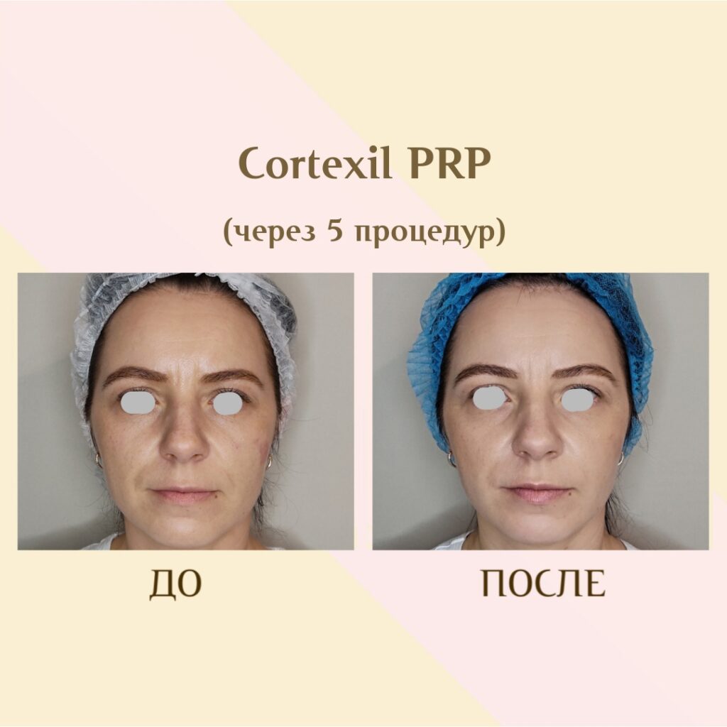 CORTEXIL PRP — плазмотерапия - до и после