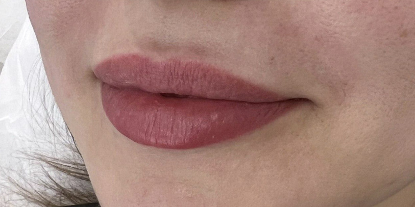 Контурная пластика - После