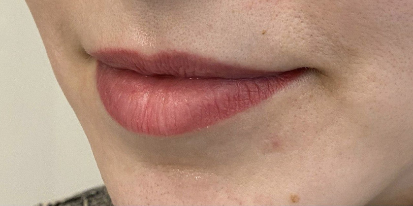 Контурная пластика - До