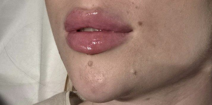 Контурная пластика - После