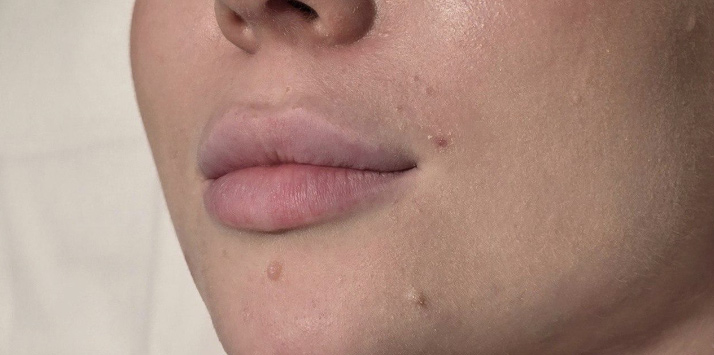 Контурная пластика - До