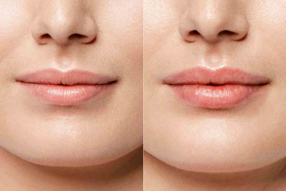 Коррекция формы губ - до и после
