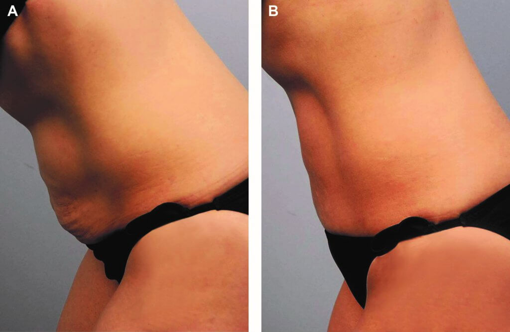 Безоперационная коррекция тела Body Tite - до и после