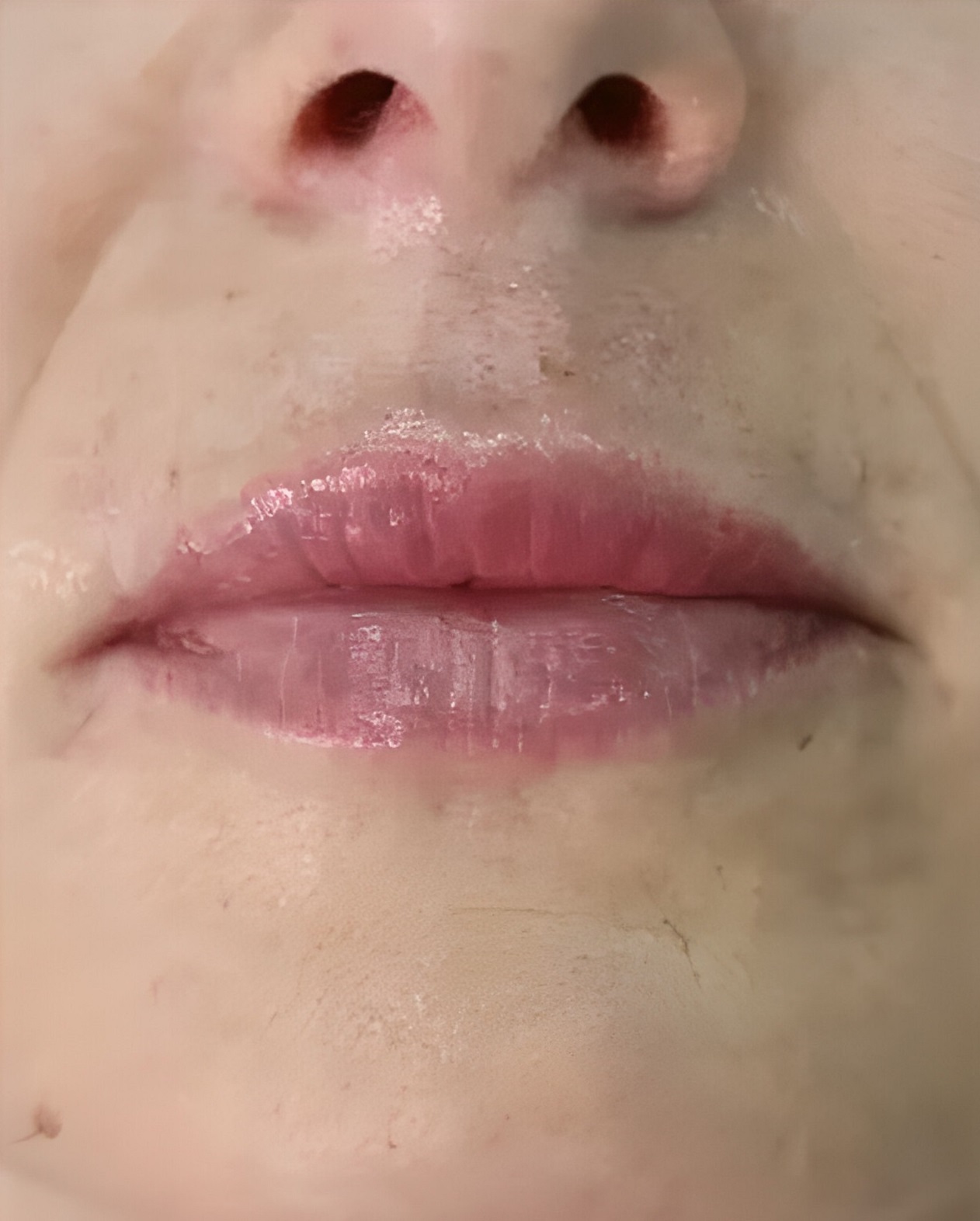Коррекция формы губ - После