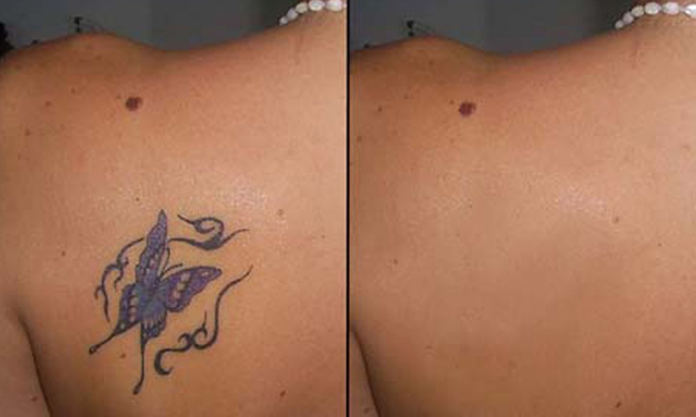 Лазерное удаление татуировок - до и после
