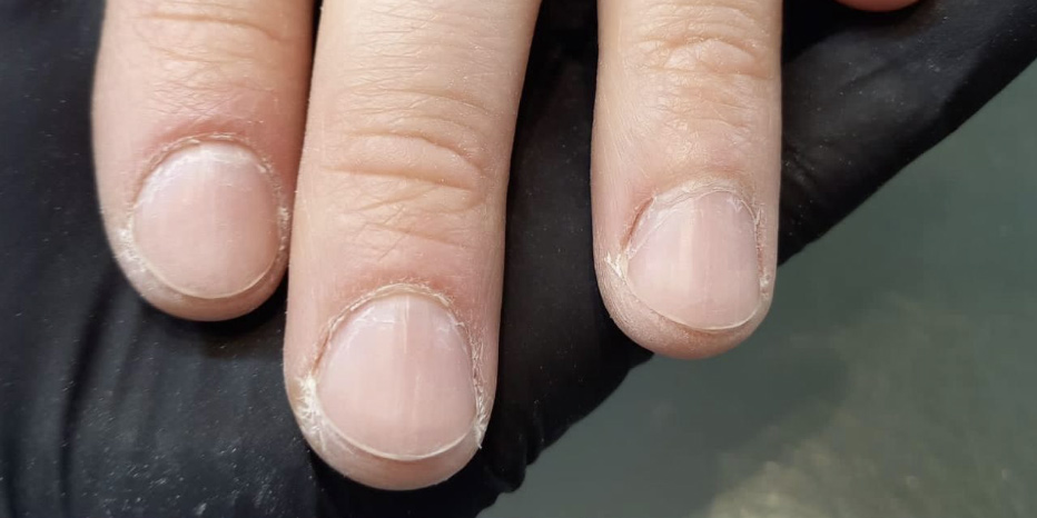 Медицинский маникюр - До