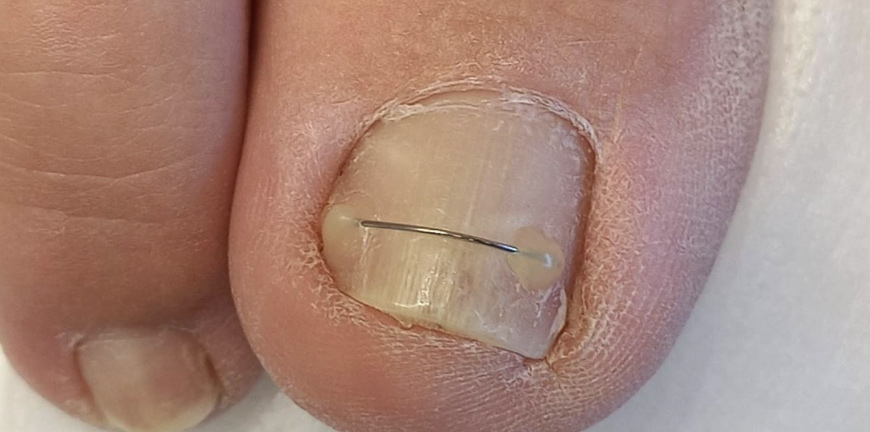 Противогрибковая лазерная терапия Pact Med - После