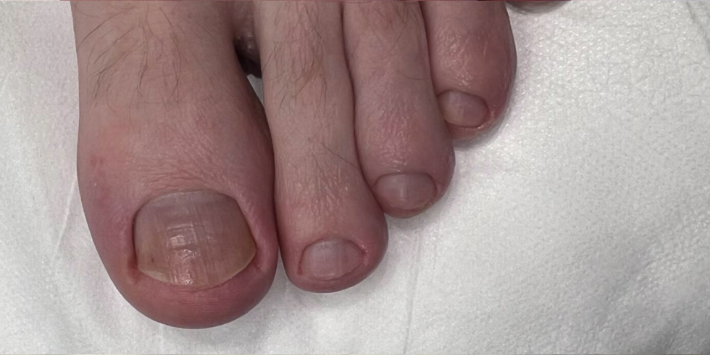 Медицинский педикюр - После