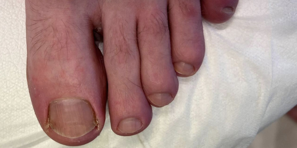 Медицинский педикюр - До