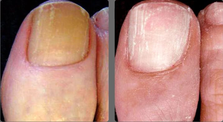 Противогрибковая лазерная терапия - до и после