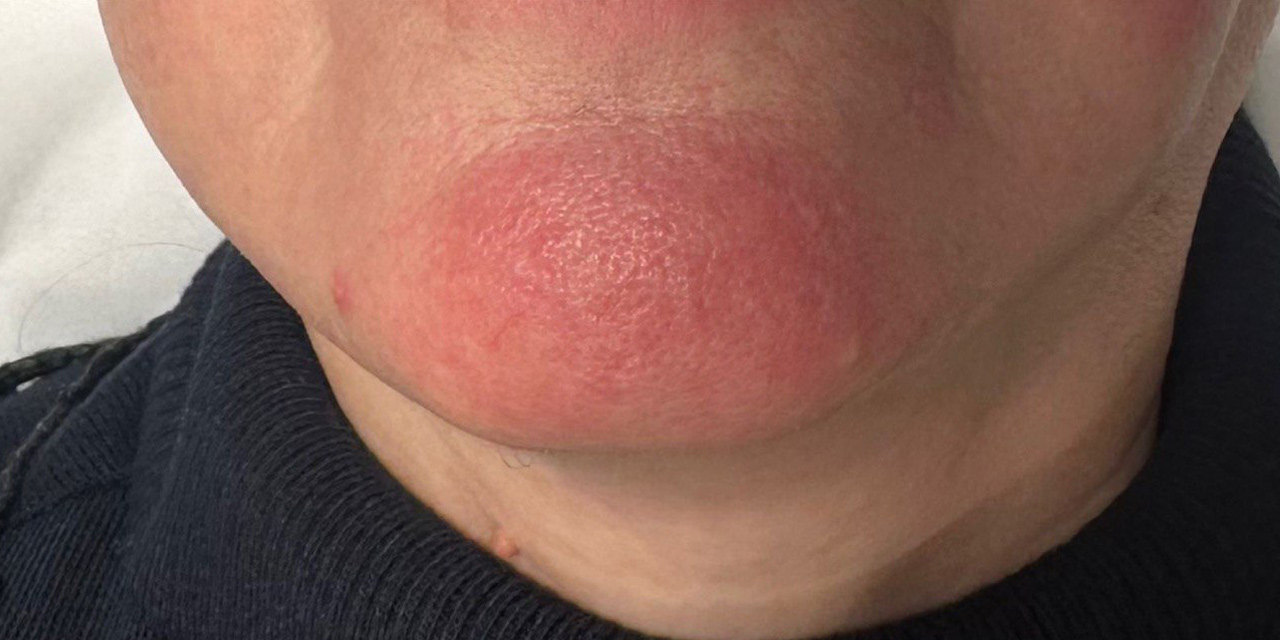 Lumecca | устранение пигментации и сосудистых дефектов - После