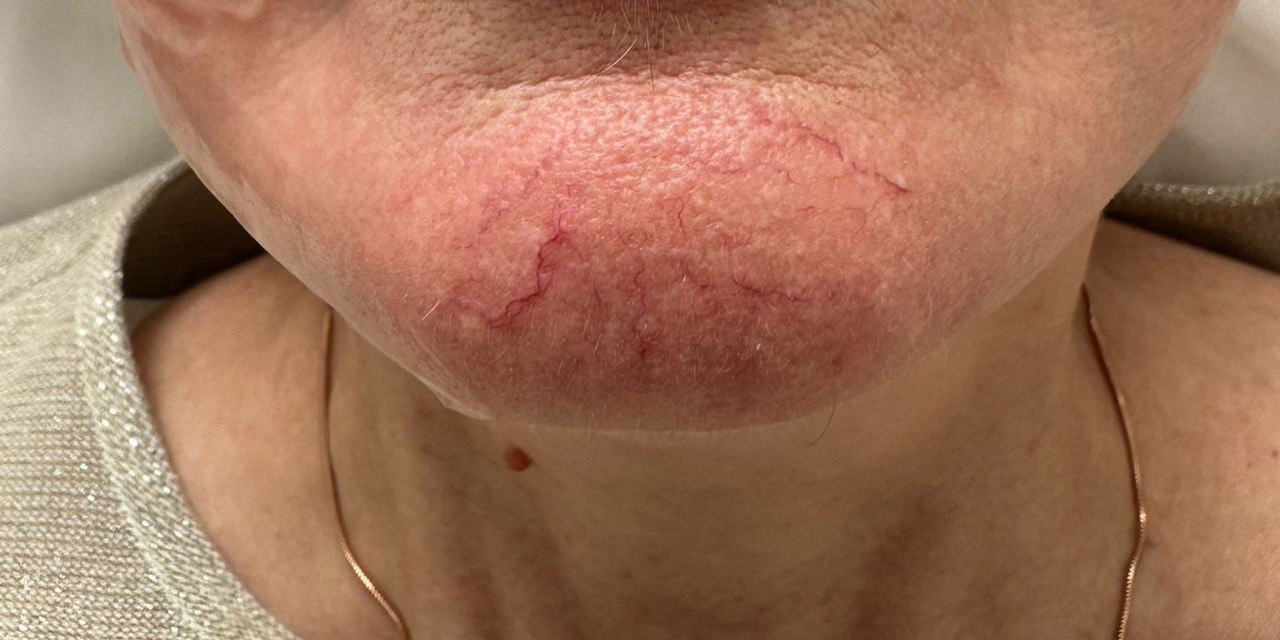 Lumecca | устранение пигментации и сосудистых дефектов - До