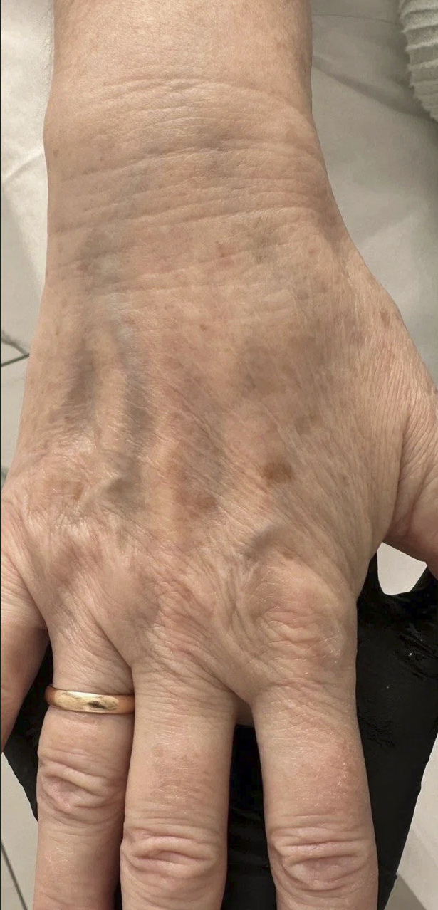 Lumecca | устранение пигментации и сосудистых дефектов - До