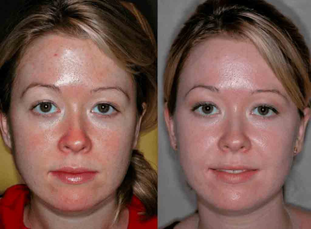 Чистка лица: зачем и как часто нужно посещать косметолога - до и после